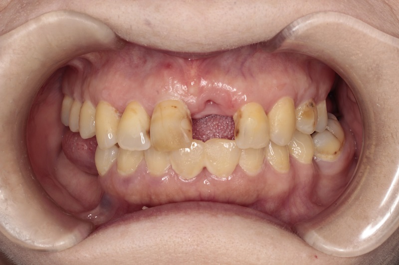 見た目を重視した前歯のインプラントのCase
